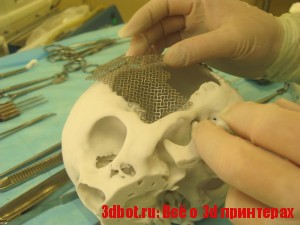 Краниопластика:  3D печать для пластики черепа