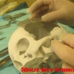 Краниопластика:  3D печать для пластики черепа