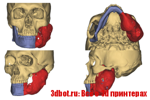 3D печать помогла в восстановлении челюсти