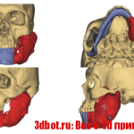 3D печать помогла в восстановлении челюсти