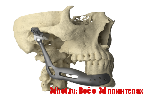 Онкологическая операцию по замене кости 3D печатным имплантом