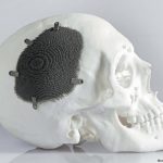 Изготовление 3D-печатных имплантатов черепа