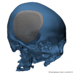 3D-печатные имплантаты для черепа