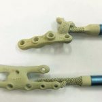 3D-печатные имплантаты костей