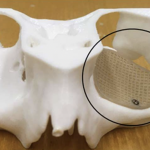 3D печатные имплантаты для лечения перелома глазниц