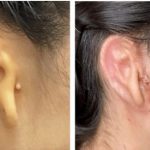 3d-печатное ухо пересадили человеку