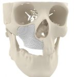 3D-печатные костные имплантаты MyBone